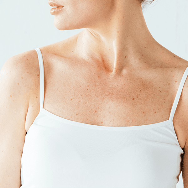 woman-decolletage-moles