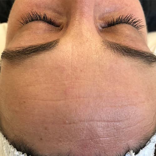 microneedling-forehead-close-up
