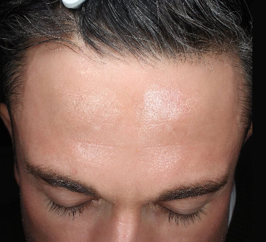 pigmentation-dermamelan-after