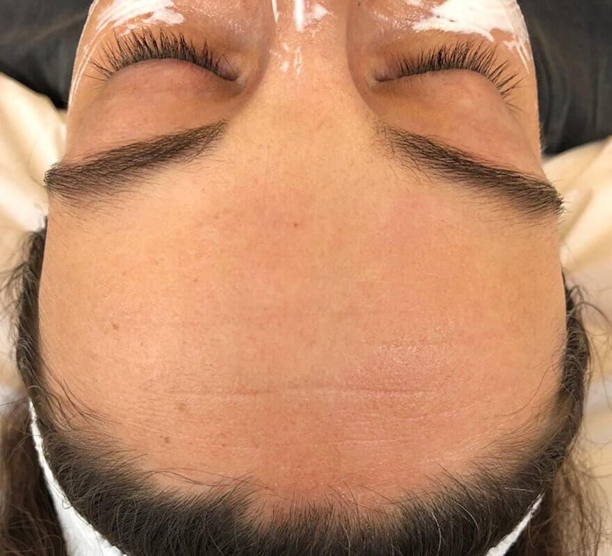 microneedling-after