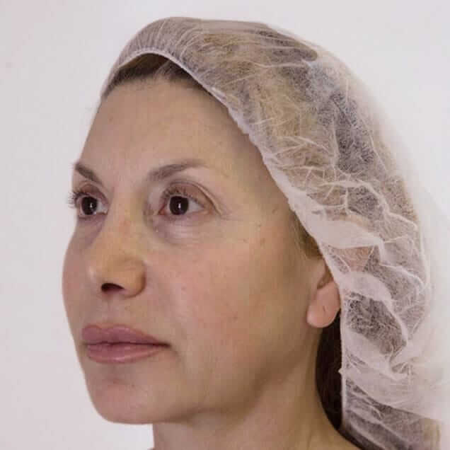hairnet-jowl-treatment-face