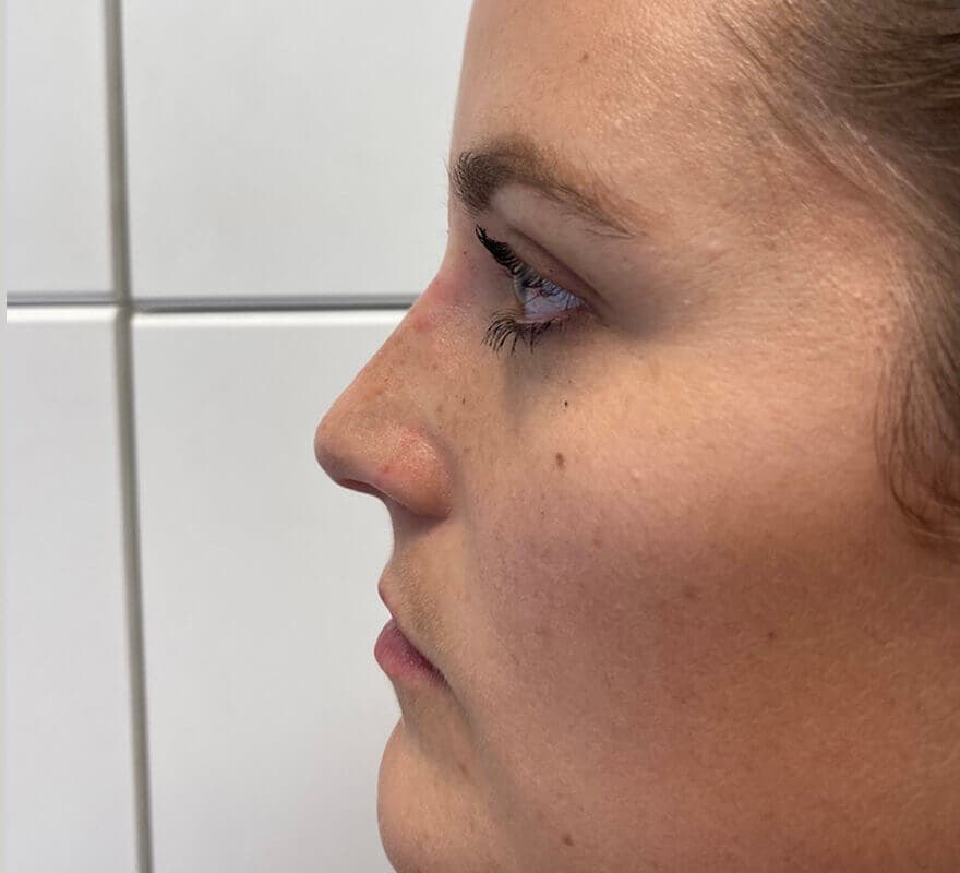 non-surgical-rhinoplasty