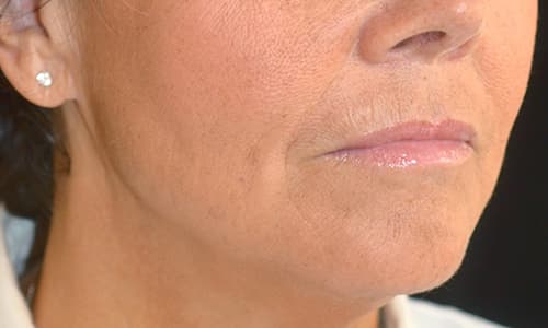 before-after-julaine