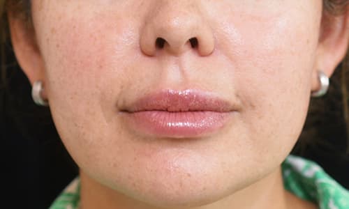 julaine-after-patient-5