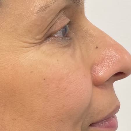 before-after-polynucleotides