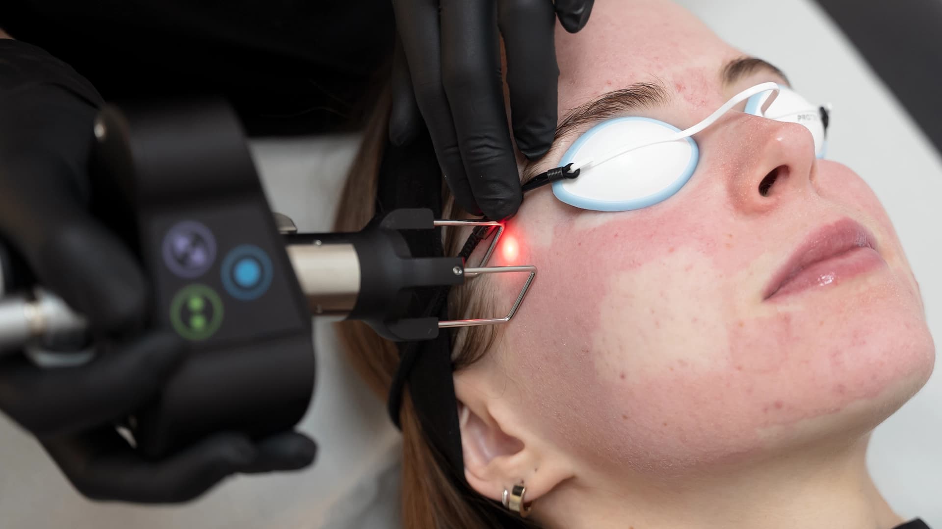 CoolPeel-laser-harleystreet