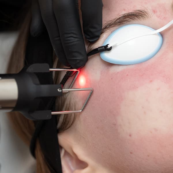 CoolPeel-Laser-harleystreet